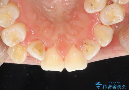 歯科矯正前のPMTCの治療後