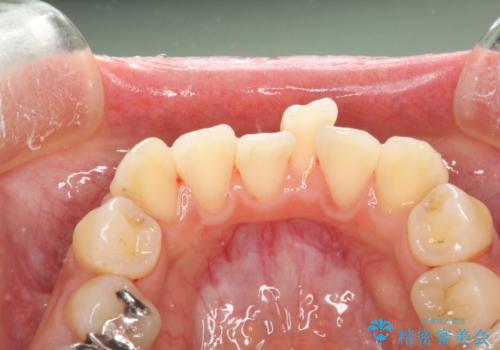 歯科矯正前のPMTCの治療後