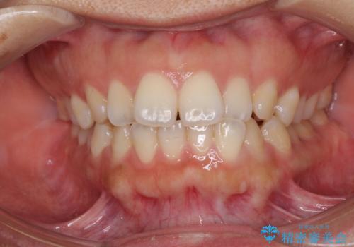 全く目立たないワイヤー矯正 上下リンガル矯正の症例 治療前