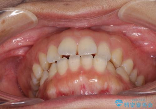 全く目立たないワイヤー矯正 上下リンガル矯正の治療前