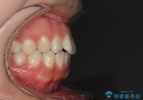 全く目立たないワイヤー矯正 上下リンガル矯正の治療前