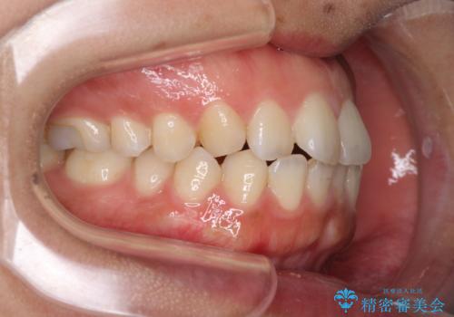 全く目立たないワイヤー矯正 上下リンガル矯正の治療前