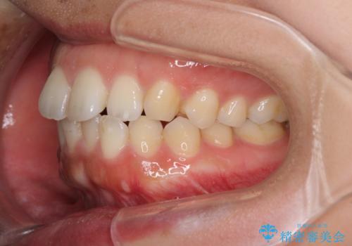 全く目立たないワイヤー矯正 上下リンガル矯正の治療前