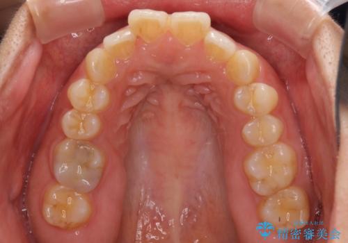 全く目立たないワイヤー矯正 上下リンガル矯正の治療前