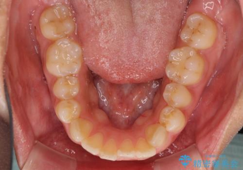 全く目立たないワイヤー矯正 上下リンガル矯正の治療前