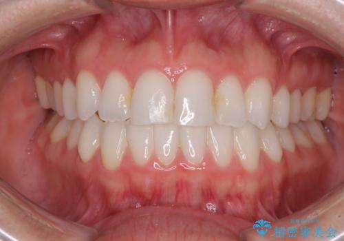 前歯のクロスバイトを治したい インビザラインによる矯正治療の症例 治療後