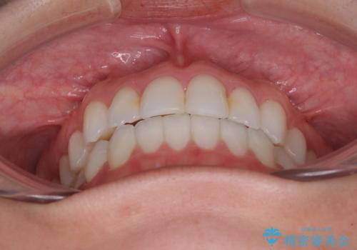 前歯のクロスバイトを治したい インビザラインによる矯正治療の治療後