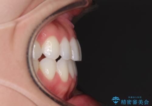 前歯のクロスバイトを治したい インビザラインによる矯正治療の治療後