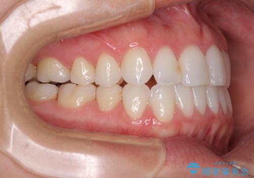 前歯のクロスバイトを治したい インビザラインによる矯正治療の治療後
