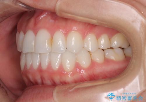前歯のクロスバイトを治したい インビザラインによる矯正治療の治療後