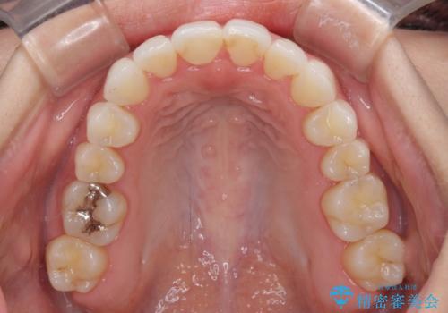 前歯のクロスバイトを治したい インビザラインによる矯正治療の治療後