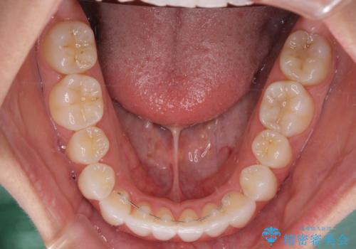 前歯のクロスバイトを治したい インビザラインによる矯正治療の治療後