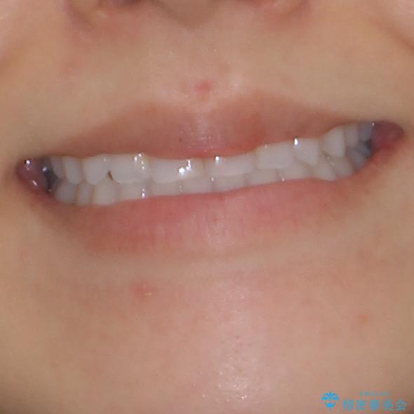 前歯のクロスバイトを治したい　インビザラインによる矯正治療の治療後（顔貌）