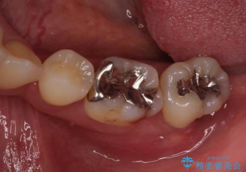 歯周病で抜歯に　奥歯のインプラント治療の治療前