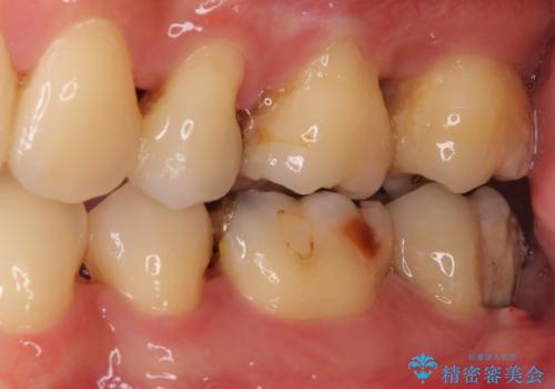 歯周病で抜歯に 奥歯のインプラント治療の治療前