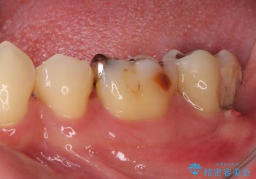 歯周病で抜歯に　奥歯のインプラント治療の治療前