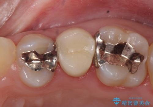オールセラミッククラウン 銀歯がしみるの治療後