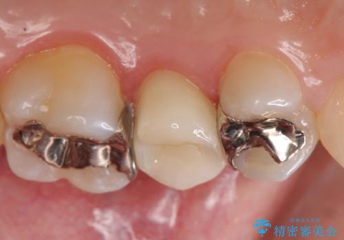 オールセラミッククラウン 銀歯がしみるの治療後