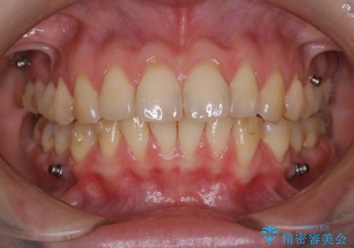 インビザライン矯正治療中のPMTCの症例 治療前