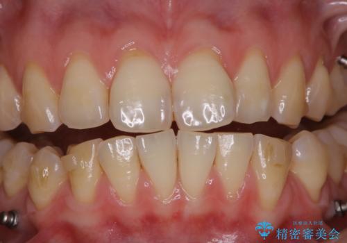 インビザライン矯正治療中のPMTCの治療前