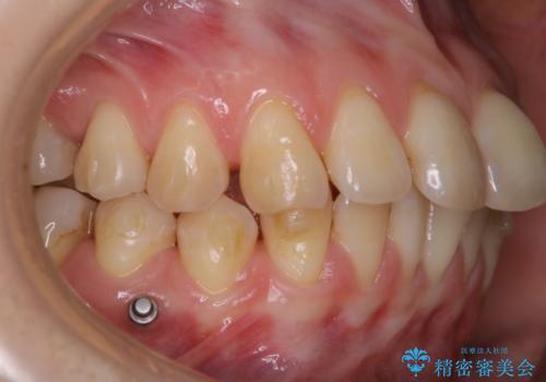 インビザライン矯正治療中のPMTCの治療前