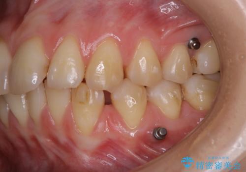 インビザライン矯正治療中のPMTCの治療前