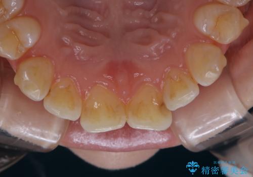 インビザライン矯正治療中のPMTCの治療前