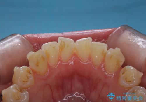 インビザライン矯正治療中のPMTCの治療前