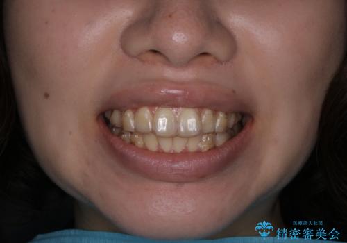 インビザライン矯正治療中のPMTCの治療前
