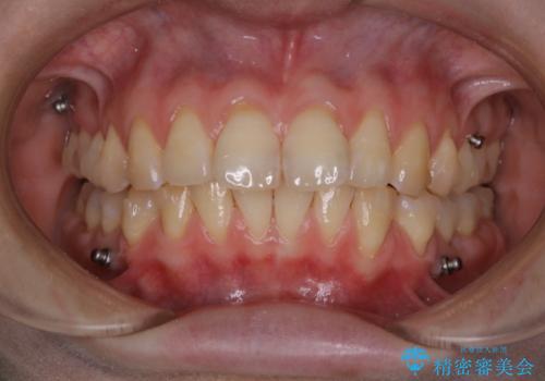 インビザライン矯正治療中のPMTCの症例 治療後