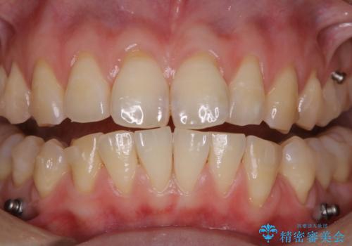 インビザライン矯正治療中のPMTCの治療後