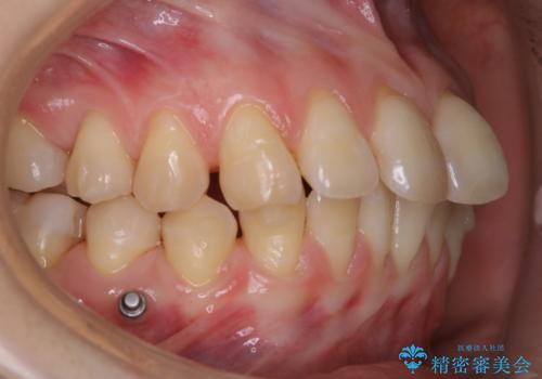 インビザライン矯正治療中のPMTCの治療後
