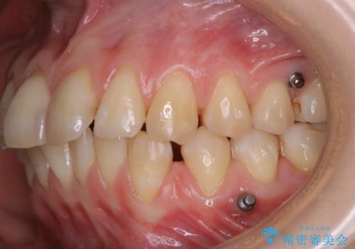 インビザライン矯正治療中のPMTCの治療後