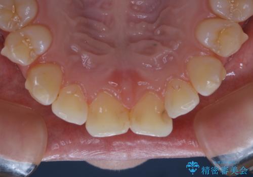 インビザライン矯正治療中のPMTCの治療後