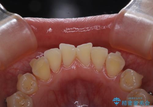 インビザライン矯正治療中のPMTCの治療後
