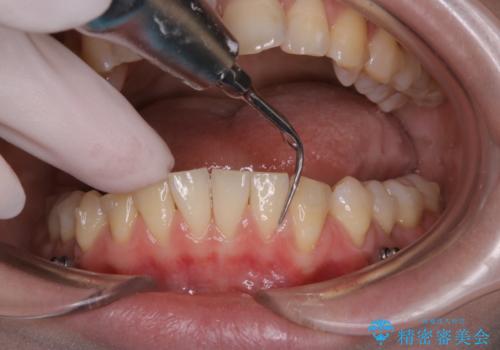 インビザライン矯正治療中のPMTCの治療中