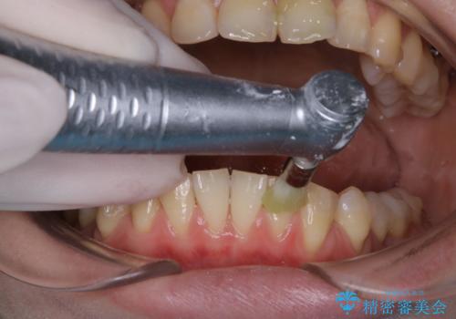 インビザライン矯正治療中のPMTCの治療中
