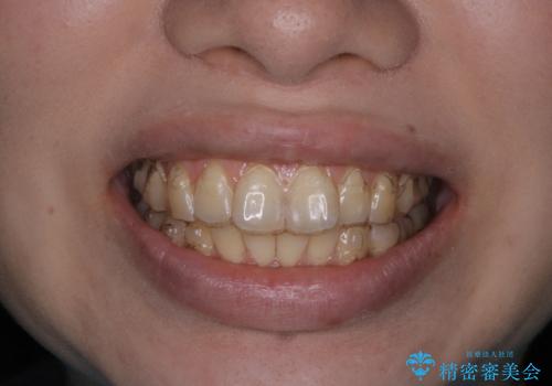 インビザライン矯正治療中のPMTCの治療後