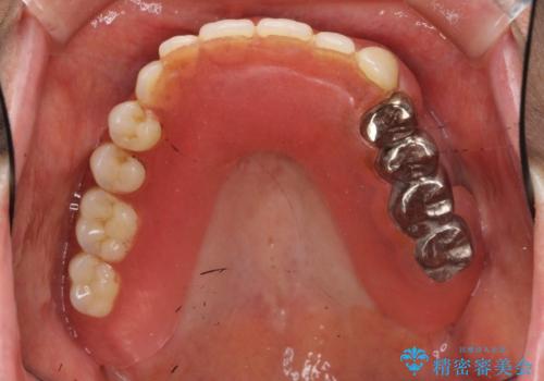 インプラントオーバーデンチャー 咬合平面の改善の治療前