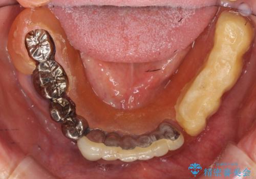 インプラントオーバーデンチャー 咬合平面の改善の治療前