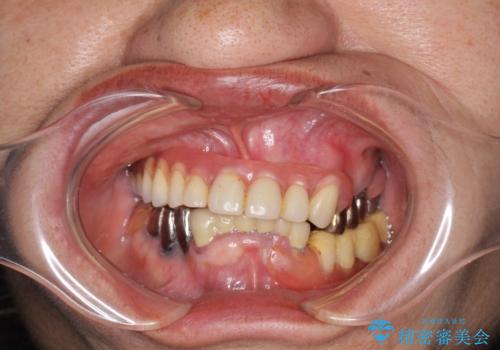 インプラントオーバーデンチャー 咬合平面の改善の治療前