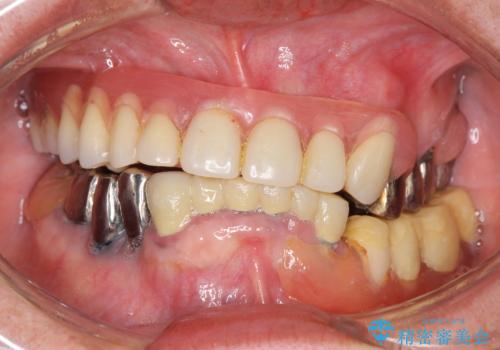 インプラントオーバーデンチャー 咬合平面の改善の治療前