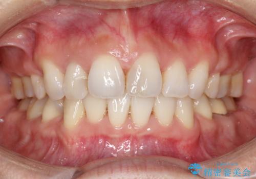 ワイヤーによる抜歯矯正でガタガタと深いかみ合わせの改善の治療後