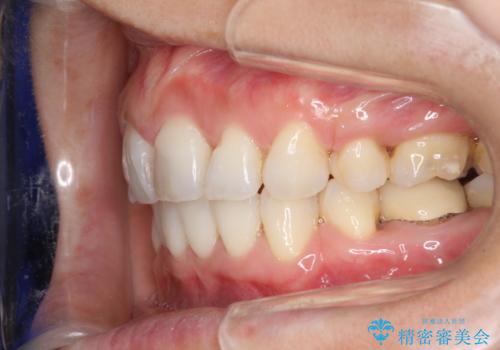ワイヤーによる抜歯矯正でガタガタと深いかみ合わせの改善の症例 治療後