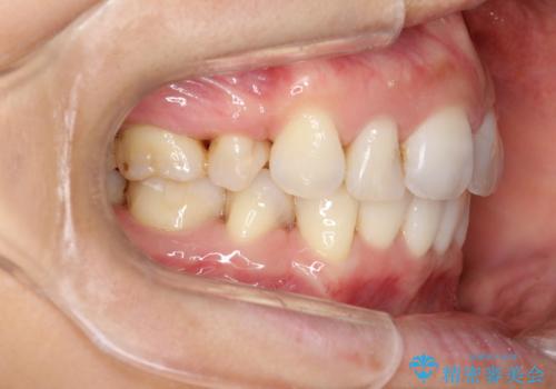 ワイヤーによる抜歯矯正でガタガタと深いかみ合わせの改善の治療後