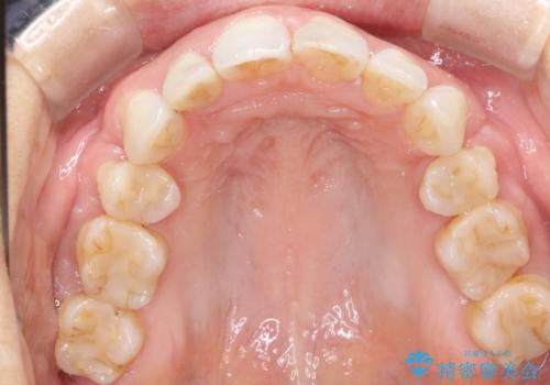 ワイヤーによる抜歯矯正でガタガタと深いかみ合わせの改善の治療後