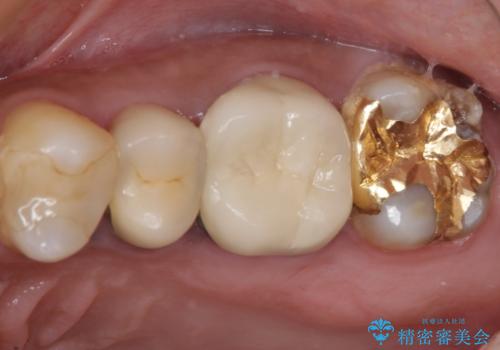 食事で痛む 神経を極力残した虫歯治療の症例 治療前