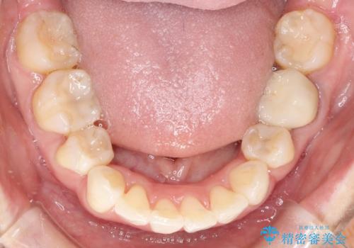 ワイヤーによる抜歯矯正でガタガタと深いかみ合わせの改善の治療後