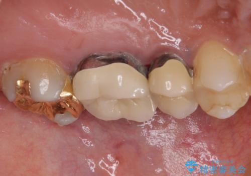 食事で痛む 神経を極力残した虫歯治療の治療前