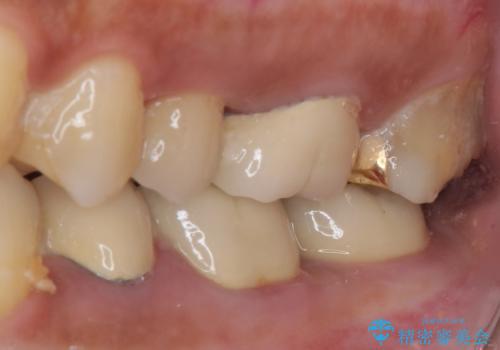 食事で痛む 神経を極力残した虫歯治療の治療前